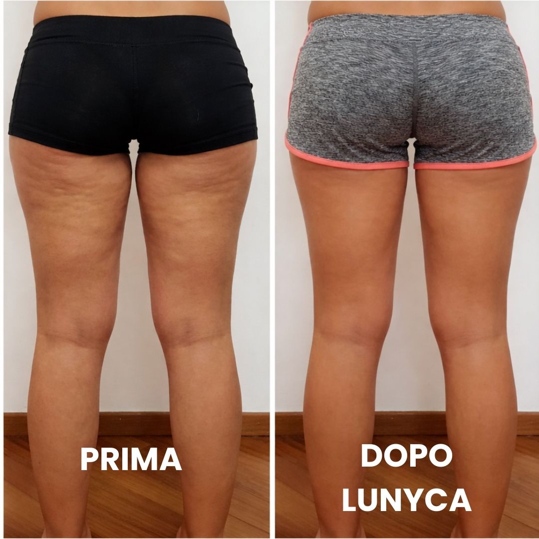Confronto fotografico 'Prima' e 'Dopo' focalizzato sulla parte posteriore delle cosce e dei glutei. Nella foto a sinistra, etichettata come 'PRIMA', la pelle presenta evidenti irregolarità dovute alla cellulite e alla ritenzione idrica. Nella foto a destra, etichettata come 'DOPO LUNYCA', la superficie cutanea appare visibilmente più levigata, compatta e omogenea, con una significativa riduzione dell'effetto a buccia d'arancia.