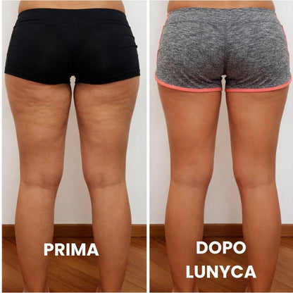 Confronto fotografico 'Prima' e 'Dopo' focalizzato sulla parte posteriore delle cosce e dei glutei. Nella foto a sinistra, etichettata come 'PRIMA', la pelle presenta evidenti irregolarità dovute alla cellulite e alla ritenzione idrica. Nella foto a destra, etichettata come 'DOPO LUNYCA', la superficie cutanea appare visibilmente più levigata, compatta e omogenea, con una significativa riduzione dell'effetto a buccia d'arancia.