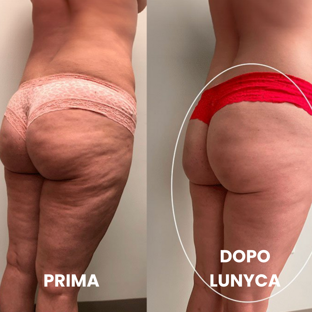 Confronto fotografico dell'efficacia contro la cellulite sui glutei e sulle cosce. La foto 'PRIMA' mostra una pelle con evidenti segni di cellulite e irregolarità cutanee (effetto buccia d'arancia). La foto 'DOPO LUNYCA', evidenziata da un cerchio bianco, mostra una significativa riduzione degli inestetismi della cellulite, con una pelle dei glutei e delle gambe che appare molto più liscia, compatta e levigata.