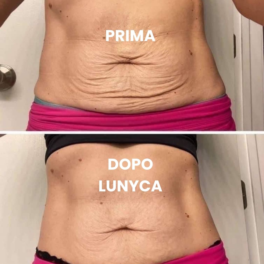 Confronto fotografico dell'efficacia di Lunyca nel rassodare la pelle dell'addome. La foto superiore, contrassegnata come 'PRIMA', mostra una pelle con evidenti segni di rilassamento cutaneo e rugosità diffusa nella zona intorno all'ombelico. La foto inferiore, contrassegnata come 'DOPO LUNYCA', mostra la stessa zona addominale con una pelle visibilmente più distesa, tonica e levigata, con una netta riduzione delle pieghe cutanee.